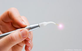 Dental-Laser: Schmerzarm und unblutig