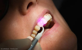 Laser beschleunigt die Zahnaufhellung