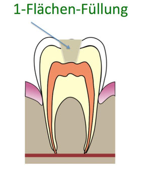 Welche ist die beste Zahnfüllung? - Donau Dental