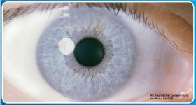 Durch die Irisdiagnose kann man viel über das Bindegewebe und die Stoffwechselsituation erkennen.