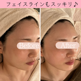 小顔ケア　ビフォーアフター