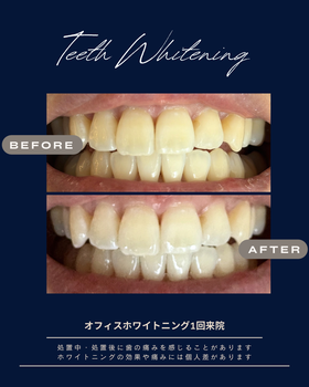 オフィスホワイトニング症例写真（ビフォアーアフター）３