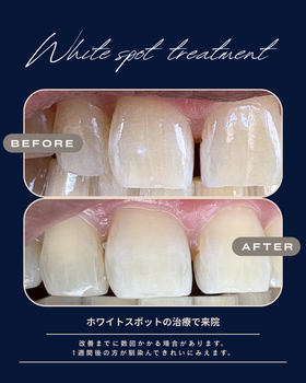 ホワイトスポット治療症例写真（ビフォアーアフター）１