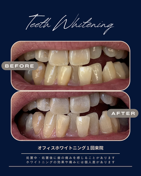 オフィスホワイトニング症例写真（ビフォアーアフター）２