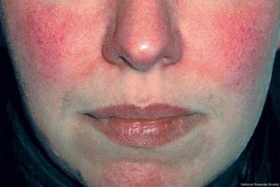 Hauterkrankungen wie Neurodermitis (atopisches Ekzem), Psoriasis (Schuppenflechte), Vitiligo (Weissfleckenkrankheit), Akne, Rosacea, periorale Dermatitis, dyshidrotisches Ekzem, nummuläres Ekzem, Lichen simplex oder Pityriasis