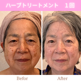 リアボーテハーブトリートメント　ビフォーアフター