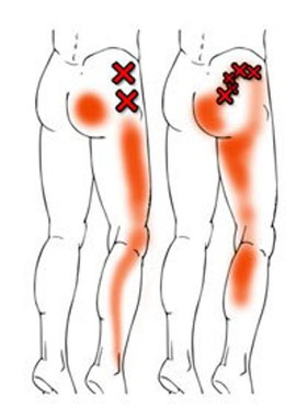「赤色」が痛みのある所 「Ｘマーク」が原因の筋肉