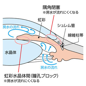 原発閉塞隅角緑内障