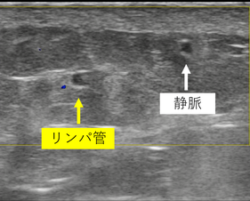 超音波検査　リンパ管　静脈　リンパ管静脈吻合術
