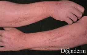 eczema severe main et bras