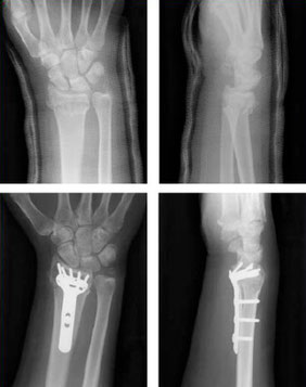 Abbildung: Versorgungsbeispiel einer distalen Radiusfraktur durch Plattenosteosynthese