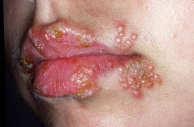 herpes infection on lips