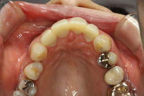 前歯の出っ歯