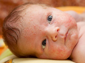 herpes infection in baby