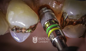 Implante Dental | Dental Implant