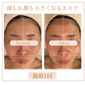 小顔ケア　ビフォーアフター