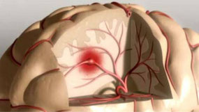 http://entremujeres.clarin.com/vida-sana/salud/ACV-prevenirlo-sintomas_0_1334275364.html