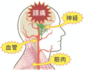 頭痛が起こる仕組みの説明図