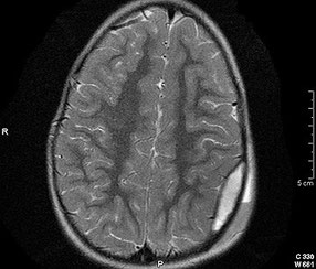 In diesem MRI des Schädels ist das Hämatom in der linken Schädelhälfte gut erkennbar.