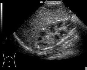 Das Beispielbild zeigt die Sonographie der Niere eines neugeborenen Kindes. 