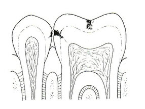 beginnende Karies