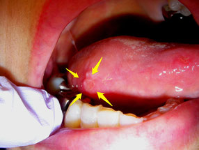 アフタ性口内炎　繰り返す場合もあります