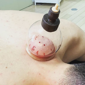 刺絡鍼法