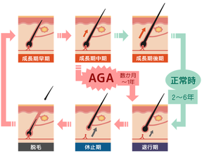 AGAの毛髪サイクル