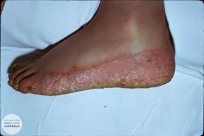psoriasis plantaire