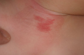 レーザー治療 保険診療内容のご案内