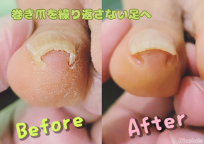 フットケア「魚の目」ビフォーアフター