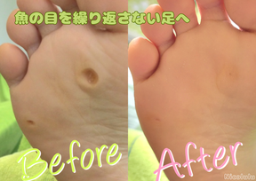 フットケア「たこ」ビフォーアフター