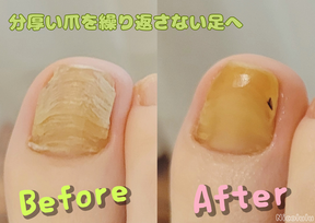 フットケア「浮き指」ビフォーアフター