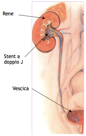 Inserimento di un catetere ureterale doppio J