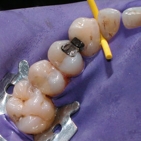 Amalgam-Entfernung unter Kofferdam (Schutzgummi) (© Dr. Hartmut Sauer)