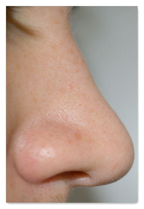 Endoskopie und Sonographie der Nase und Nasennebenhöhlen - HNO ...