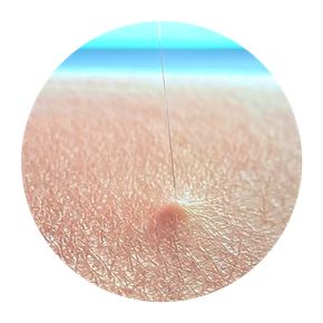 depilacion laser gijon y oviedo laser diodo alejandrita pelo