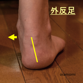外反足、後脛骨筋炎、踵異常、足首痛、昭島市のオサモミ整体院
