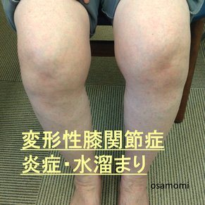 関節を守りなが生活、変形性膝関節症、痛みや炎症には、サラシ固定。昭島市のオサモミ整体院