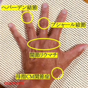 ヘバーデン結節、ブシャール結節、関節リウマチ、CM関節症、昭島市のオサモミ整体院
