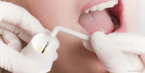 Zur professionellen Zahnreinigung gehört auch die Härtung des Zahnschmelzes mit Fluoriden.