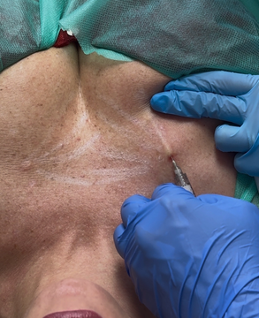 Radiesse Dekollete Expertin Ärztin für Ästhetische Medizin Arztpraxis Silke Ebert München