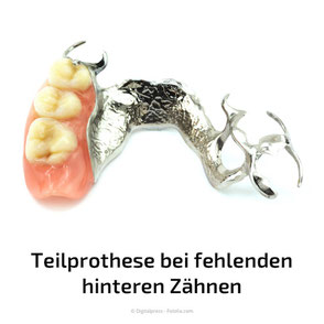 Feste Zähne mit Implantaten statt herausnehmbare Teilprothesen