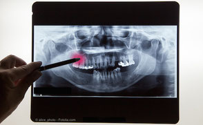 Röntgen-Aufnahme von Zähnen und Kiefer