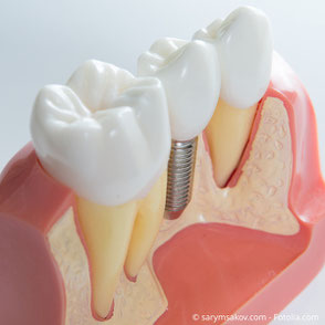 Implantat Zahnarzt Burgau Dres Forstner