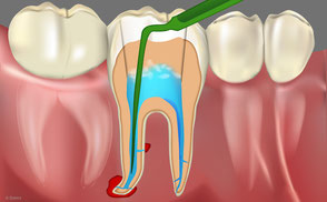 Spülung der Wurzelkanäle zur Beseitigung von Geweberesten und Bakterien