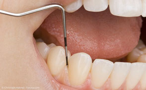 Parodontose-Behandlung bei starker Zahnfleischentzündung, Zahnfleischschwund und Zahnlockerung