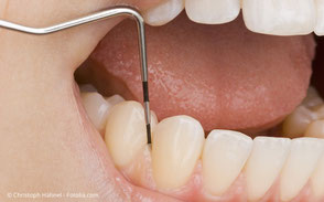 Messung der Zahnfleischtaschen-Tiefe