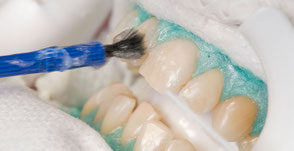 Power-Bleaching: Auftragen des Gels