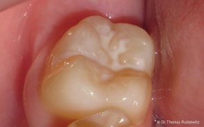 Großer Backenzahn mit Fissurenversiegelung